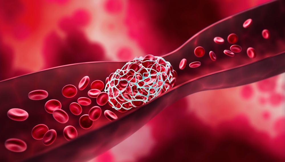 Blood clot blocking a blood vessel - 3D illustration